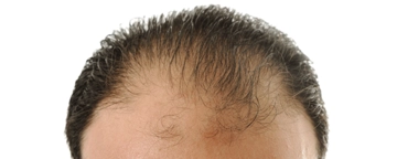 Çinko Eksikliği Saç Dökülmesi